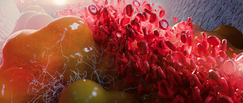 Fat cells,  adipocyte and lipocyte, cholesterol in a cells, blocked vessel in high level of LDL (bad cholesterol) lipoprotein,  risks of heart disease, metabolic syndrome and diabetes