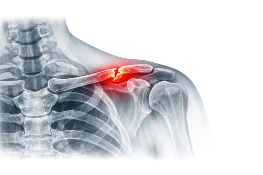 Shoulder clavicle fracture painful injury X ray medical anatomy bone damage orthopedic trauma 3D illustration isolated on white background