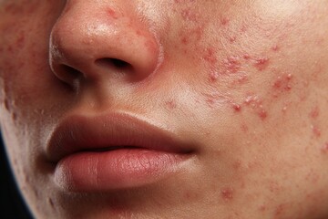 Fototapeta premium Close-up of human skin with acne and blemishes on the face