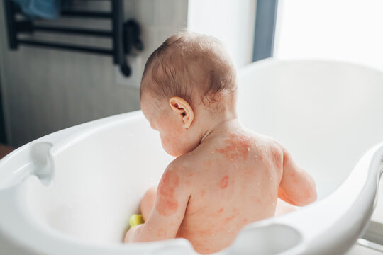 Atopic dermatitis skin care routine. Bathing little baby girl with eczema. Red dry itchy spots on child's body. Taking care of kid