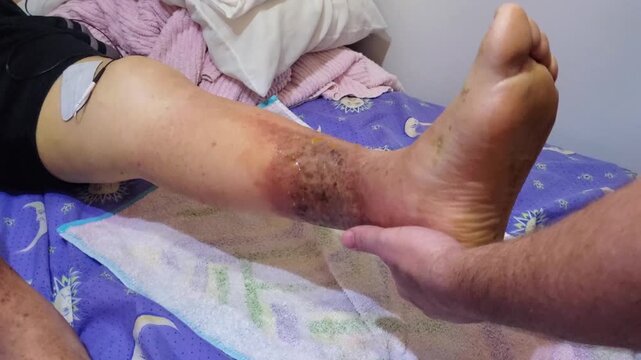 Physical therapist applying electrotherapy and assisted movement to a patient&rsquo;s leg during rehabilitation treatment after femur fracture