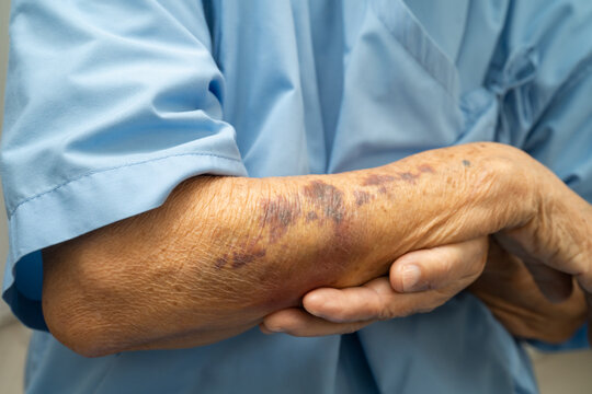 Ecchymosis, elderly bleeding on her arm after taking aspirin.