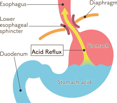 胃酸の逆流のイラスト　Acid reflux illustration
