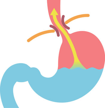胃酸の逆流のイラスト　Acid reflux illustration