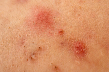 Fototapeta premium Pimple close up with pore texture detail on skin. Acne close up shows pimple with whitehead comedone and sebum. Pimple acne close up for dermatology. Close up acne skin problem with papules.
