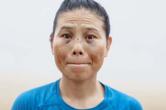 Miserable asian woman with bruised eyes hit by a surfboard looking at the camera