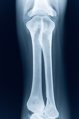 Xray image of human leg bones from the front view transparent background