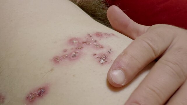 A patient with a rash caused by herpes zoster virus on the back. The doctor examines the rash and explains the condition and its effects.