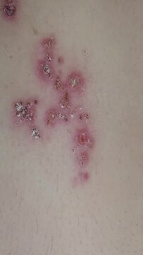 The presentation shows a rash caused by herpes zoster virus on a patient's back. The patient discusses symptoms and care strategies for the infection.