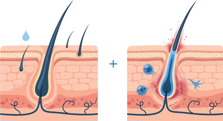 Skin hair follicle anatomy with and without inflammation