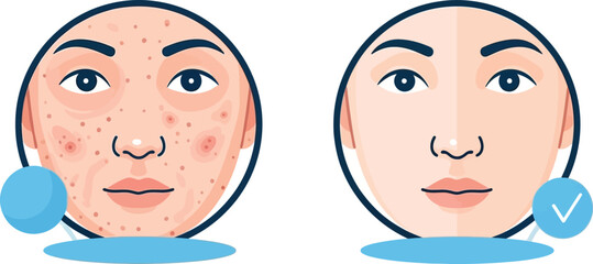 Before and after acne treatment illustration of woman's face