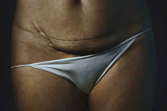 Abdomen with surgical scar and stretch marks showing body positivity