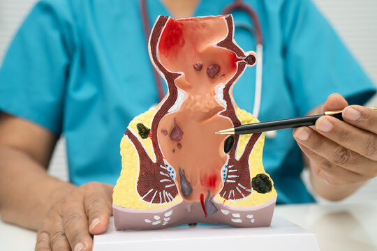 Asian doctor with rectum and hemorrhoid human model, inflamed vascular structure.