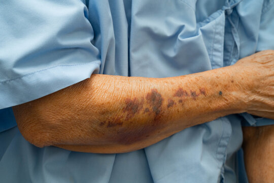 Ecchymosis, elderly bleeding on her arm after taking aspirin.