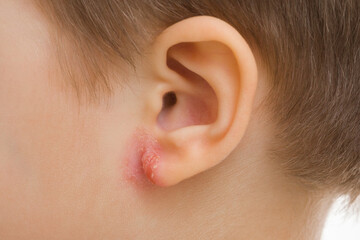 Toddler boy ear with red rash. Skin allergy treatment. Closeup. Front view.