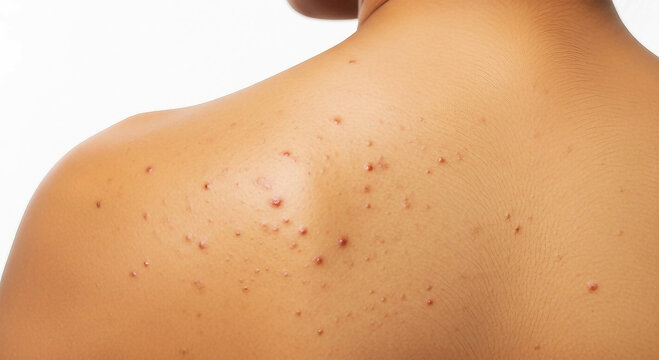Close up of human back skin with acne blemishes and red spots image