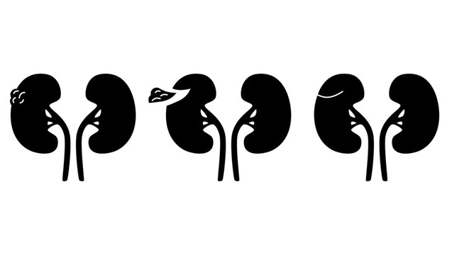 nephrectomy kidney, black isolated silhouette