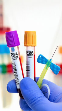 Gloved hand holding PSA total and PSA free blood test tubes for prostate cancer screening in laboratory.