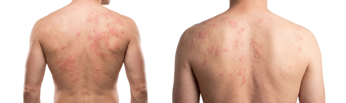 Collection of Two different Men in Skin Rash and Red Spots, Ringworm Patches on back isolated on transparent background Cutout PNG