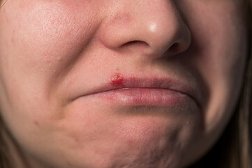 Fototapeta premium Extreme close up of a young woman's face showing a red painful herpes cold sore blister on her upper lip with visible skin texture