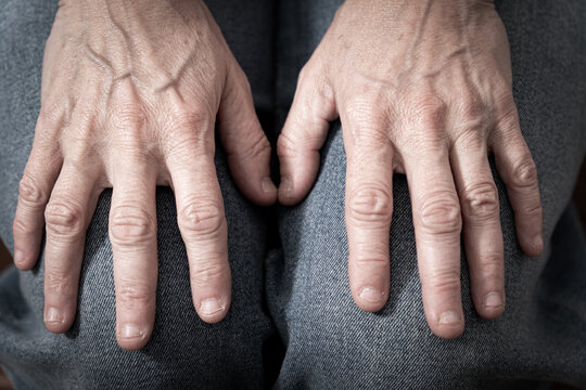 Close-up of older adult female hands with biting nails on fingers resting on knees, showing wrinkles and veins, symbolizing aging, health, time, and human vulnerability.