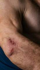 Naklejka premium Person recovering from elbow injury with wound healing