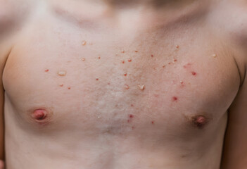 Fototapeta premium Child chest showing molluscum contagiosum skin infection