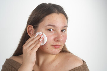 Acne treatment with cotton pad for skincare. Acne care for sensitive face. Acne hygiene and skin care. Skin with pimple cleansing. Pimple facial issue. Pimple skincare. © Svitlana