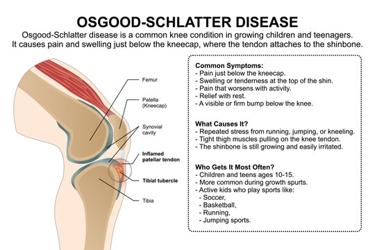 Osgood&ndash;Schlatter Disease Education Flashcard