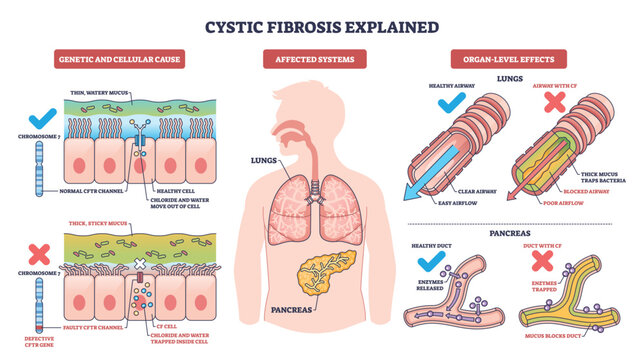 Cystic fibrosis explained, visual summary of CFTR mutation causing thick mucus in lungs and pancreas, contrasting clear and blocked airways to show disease effects. Outline diagram