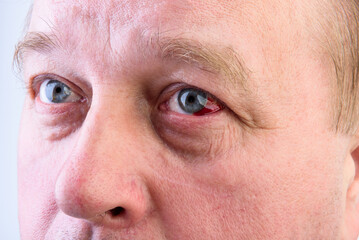 A man's eye with a burst vessel and blood leaking into the eyeball, hemorrhage on gray background.