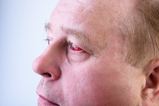 A man's eye with a burst vessel and blood leaking into the eyeball, hemorrhage on gray background.