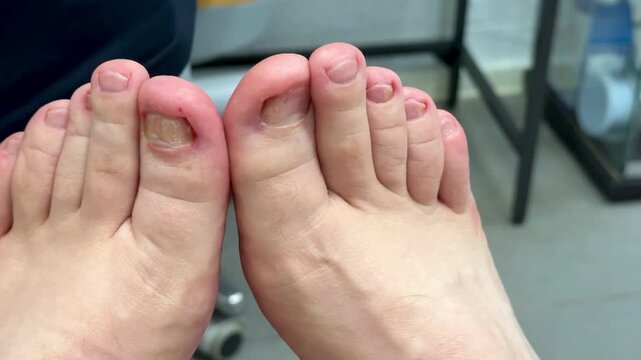 Closeup Caucasian foot after podiatry treatment showing thick yellow toenail consistent with onychomycosis, surrounding redness and mild swelling, visible debridement marks, clinical chair