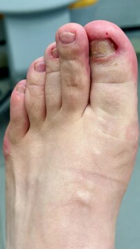 Closeup Caucasian foot after podiatry treatment showing thick yellow toenail consistent with onychomycosis, surrounding redness and mild swelling, visible debridement marks, clinical chair
