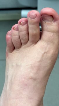 Closeup Caucasian foot after podiatry treatment showing thick yellow toenail consistent with onychomycosis, surrounding redness and mild swelling, visible debridement marks, clinical chair