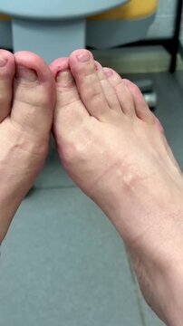 Closeup Caucasian foot after podiatry treatment showing thick yellow toenail consistent with onychomycosis, surrounding redness and mild swelling, visible debridement marks, clinical chair