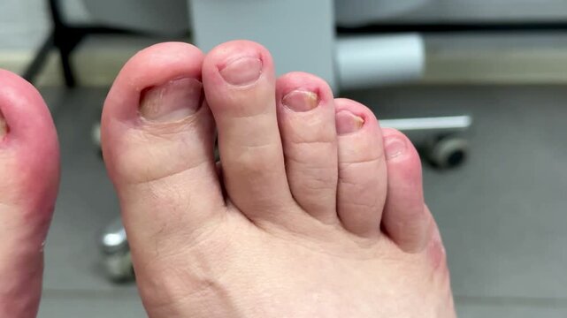 Closeup Caucasian foot after podiatry treatment showing thick yellow toenail consistent with onychomycosis, surrounding redness and mild swelling, visible debridement marks, clinical chair