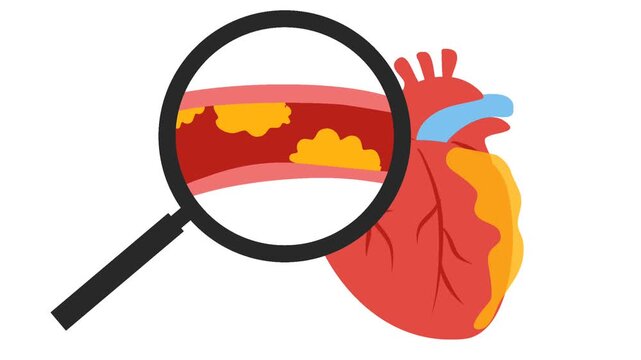 Coronary artery disease medical illustration. Heart blockage and atherosclerosis animation