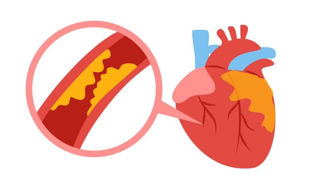 Coronary artery disease medical illustration. Heart blockage and atherosclerosis animation