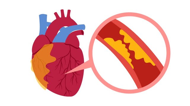 Coronary artery disease medical illustration. Heart blockage and atherosclerosis animation