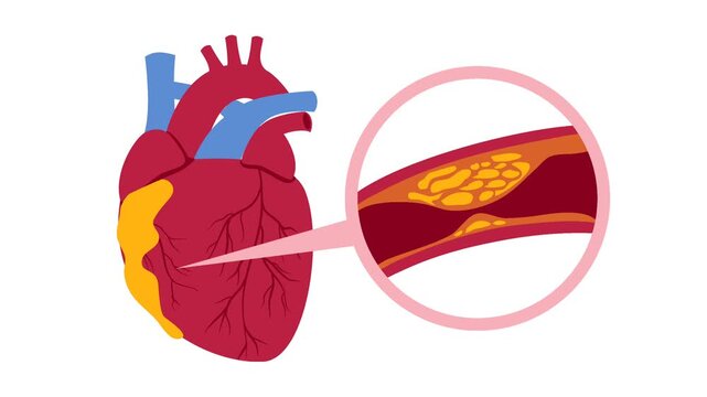 Coronary artery disease medical illustration. Heart blockage and atherosclerosis animation
