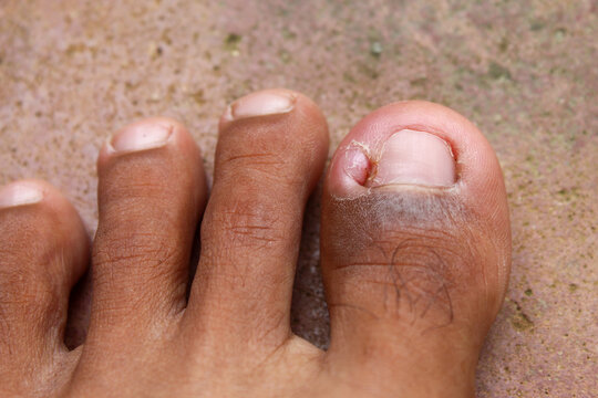 A person's big toe is inflamed, red, and swollen around the nail (hanging nail). Showing signs of fungal or bacterial infection of the toenail.