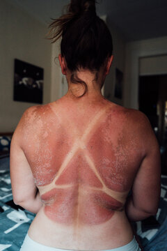 Sunburn on Back With Tan Lines After Beach Day in Summer