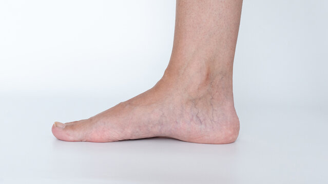 Flat foot condition displayed in a side view of a human foot, highlighting the archless structure and its implications for mobility and comfort