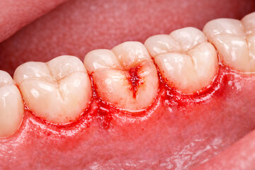 Gingivitis and Inflamed Gums Along Teeth