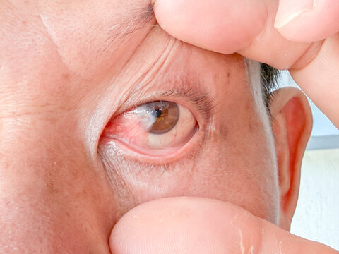 close up of a man face irritated red eye with inflamed conjunctiva.