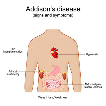 Addison's disease. Signs and symptoms of Adrenal glands disorder.