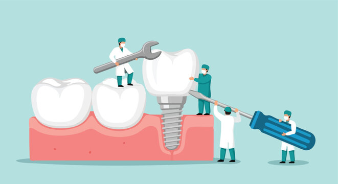 Dental Implant Procedure. Tooth Restoration. Medical Illustration. Flat Design.