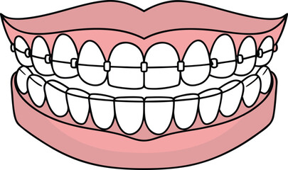 Obraz premium Orthodontics Dental Care Illustration. Dental Braces Treatment Illustration. Orthodontic Teeth Alignment Illustration. Modern Orthodontics Dental Illustration. Dental Clinic Orthodontics Illustration