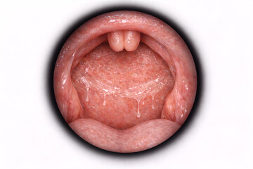 Obraz premium Photorealistic 3D visualization of the human oropharynx and upper throat showing mild phlegm buildup: a thin translucent mucus film and a few subtle stringy strands on the posterior pharyngeal wall